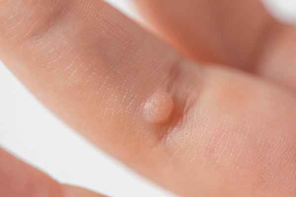 Wart Removal