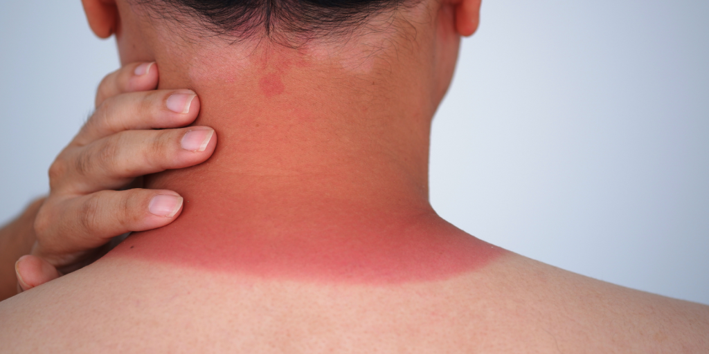 How Dermatologists Aid In Sunburn Treatment And Aftercare
